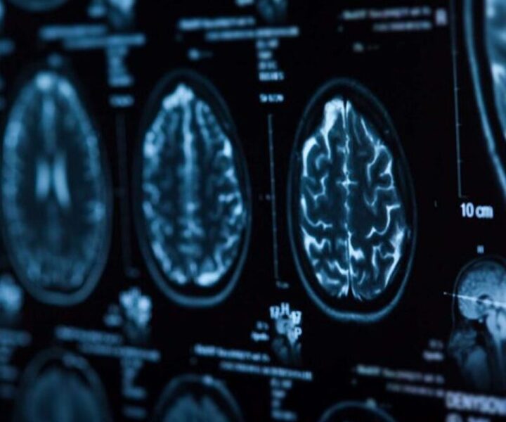 brain-scan 1